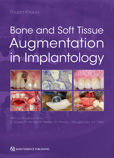 Bone and Soft Tissue Augmentation in Implantology - 