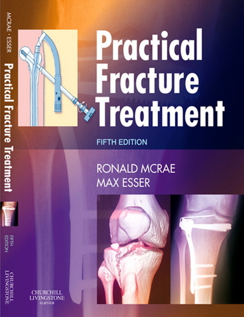 Practical Fracture Treatment E-Book -  Ronald McRae,  Max Esser
