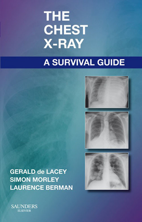 Chest X-Ray: A Survival Guide -  Laurence BERMAN,  Gerald de Lacey,  Simon MORLEY