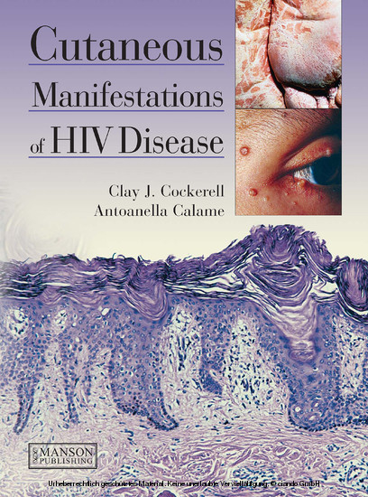 Cutaneous Manifestations of HIV Disease -  Antoanella Calame,  Clay Cockerell