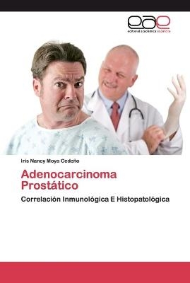 Adenocarcinoma Prostático - Iris Nancy Moya Cedeño