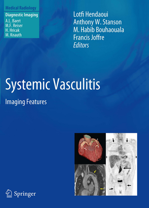 Systemic Vasculitis - 