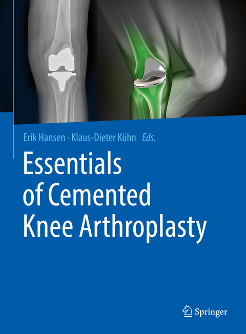 Essentials of Cemented Knee Arthroplasty - 
