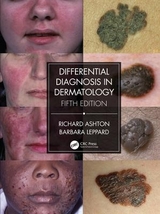 Differential Diagnosis in Dermatology - Ashton, Richard; Leppard, Barbara