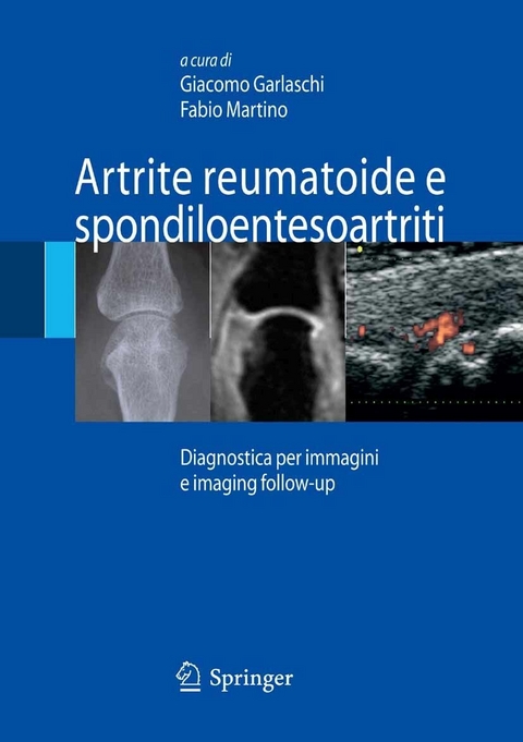 Artrite reumatoide e spondiloentesoartriti - 