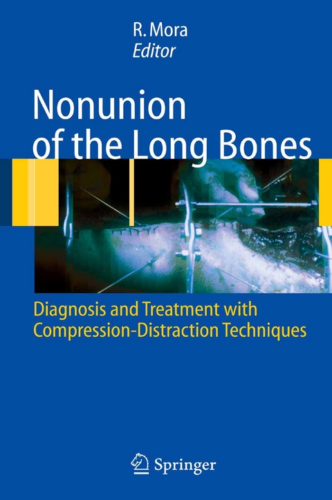 Nonunion of the Long Bones - 