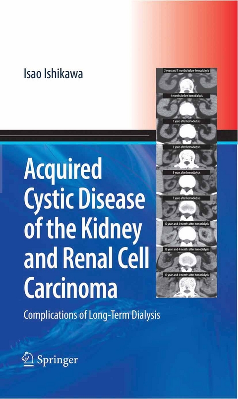 Acquired Cystic Disease of the Kidney and Renal Cell Carcinoma -  Isao Ishikawa