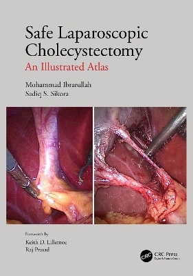 Safe Laparoscopic Cholecystectomy - Mohammad Ibrarullah, Sadiq S Sikora