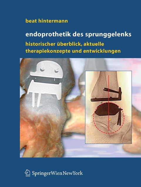 Endoprothetik des Sprunggelenks - Beat Hintermann