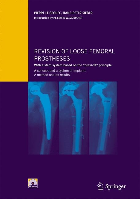 Revision of loose femoral prostheses with a stem system based on the &quote;press-fit&quote; principle -  Pierre LE BEGUEC,  Hans-Peter Sieber