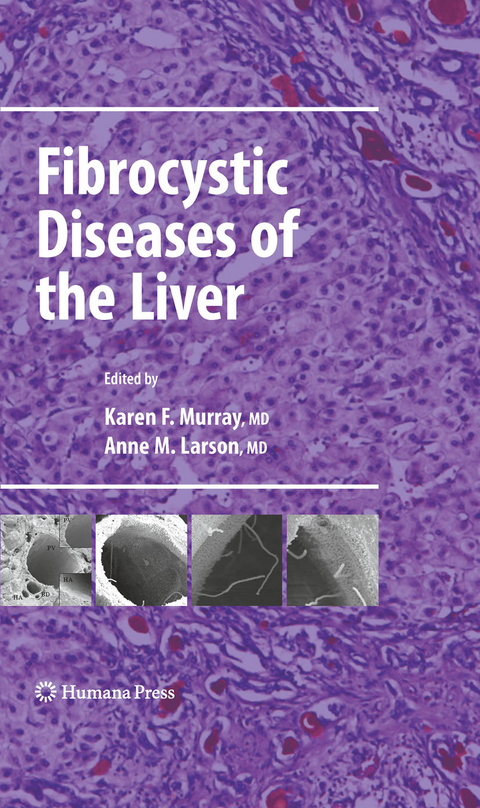 Fibrocystic Diseases of the Liver - 