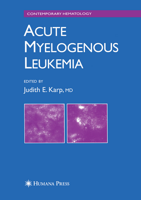 Acute Myelogenous Leukemia - 