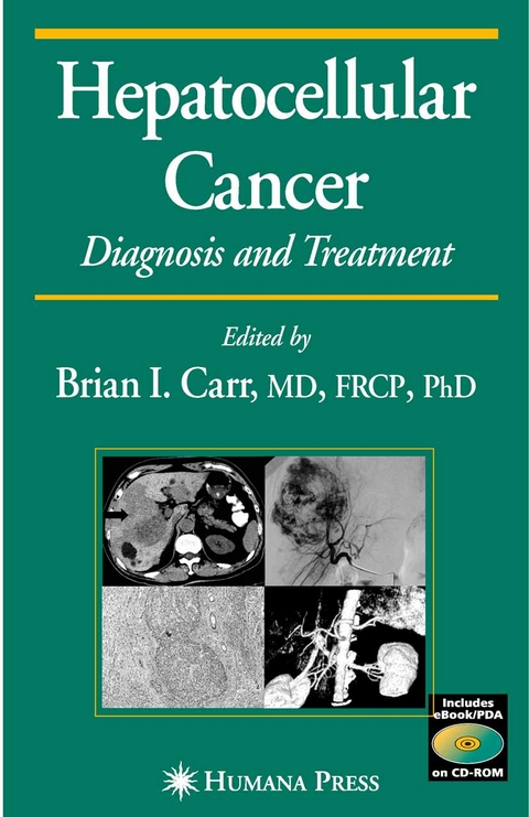 Hepatocellular Carcinoma -  Brian I. Carr